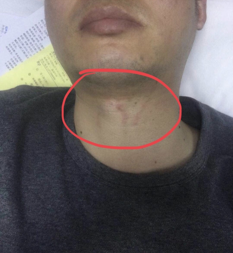 丁师傅表示,事后他的脖子也留下了明显的红印子.