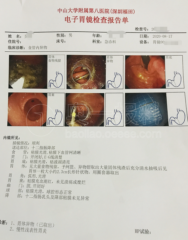胃镜诊断报告单图片