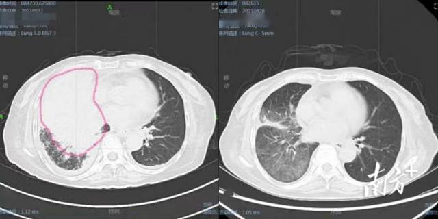 魏女士治疗前(粉红色圈圈内为肺肿瘤)和治疗后(肿瘤几乎消失)ct图像