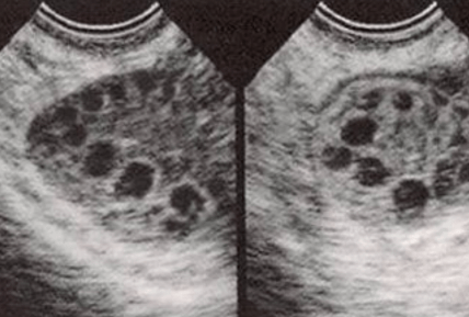一30岁女子半年未孕也没月经，医生提醒：警惕这些症状